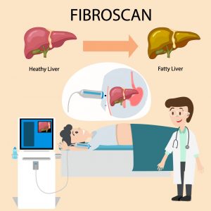 Facts to Know about FibroScan®